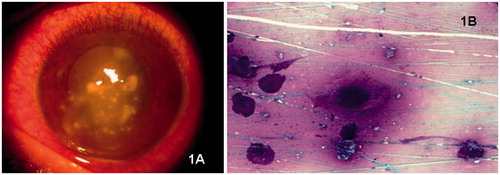 FIGURE 1. (A) Giemsa staining of smear showing microsporidial spores. (B) Clinical photograph showing multiple corneal infiltrates at the time of presentation in a case with post-collagen cross-linking keratitis.