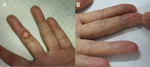 Figure 1 (A) A thumb-sized mass is seen on the ventral aspect of the second finger of the left middle finger, (B) A peanut-sized mass is seen on the ventral aspect of the terminal phalanx of the left middle finger.