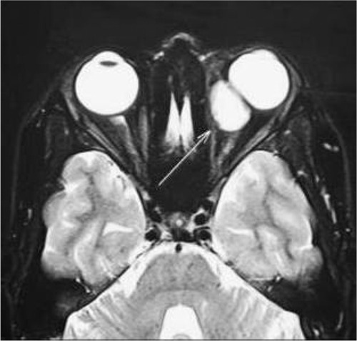 Figure 3 Magnetic resonance imaging (axial section) showing intraconal mass lesion in the left orbit (arrow).