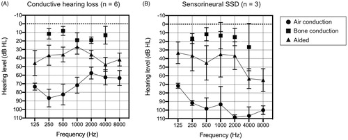 Figure 1. The average ADHEAR-aided thresholds and the pure tone average for air conduction and bone conduction thresholds at 3 months after use. (A) In conductive hearing loss patients (n = 6) and (B) SSD patients (n = 3). With the use of the adhesive hearing device, ADHEAR, the aided thresholds were improved on average by 36.5 dBHL and 45.0 dBHL for the conductive hearing loss subgroup and the SSD subgroup, respectively. Bone conduction thresholds in the SSD group indicate hearing levels in the contralateral, healthy ear (B). SSD: sensorineural single-sided deafness.