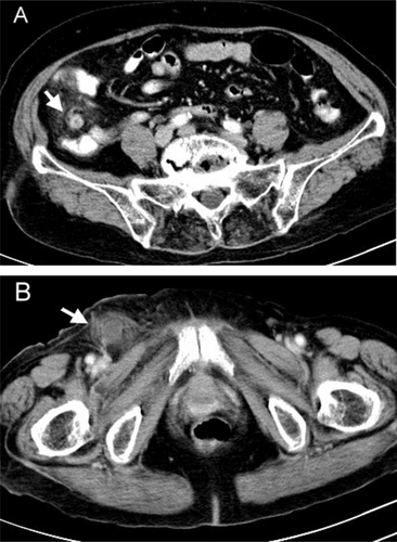 Figure 1 Abdomen CT with intravenous and oral constrast demonstrating swelling of appendix, thickened wall of cecum and perifocal fat stranding (A). The fluid-contained hernia sac was seen lateral and inferior to the pubic tubercle, with circumferential fat stranding (B).
