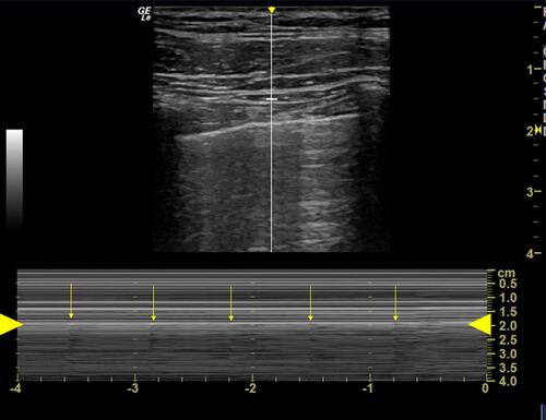 Figure 3 Bar code sign in an adult. M-mode point-of-care ultrasound. Numerous horizontal lines are seen both above and below the pleural line (between large yellow arrows). This is known as the bar code sign (stratosphere sign), which suggests the absence of lung sliding and the fact that the lung is not ventilated. Artifact created by the heart beat is detected at constant intervals (small yellow arrows).