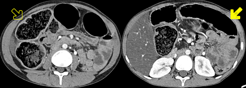 Figure 5 Axial CECT showing symmetric concentric thickening and redundancy of the proximal portion of the colon (open arrow): particularly, the ascending colon, hepatic flexure and proximal half of transverse colon, compared to the distal portion of the transverse colon with normal wall thickness (shaded arrow).