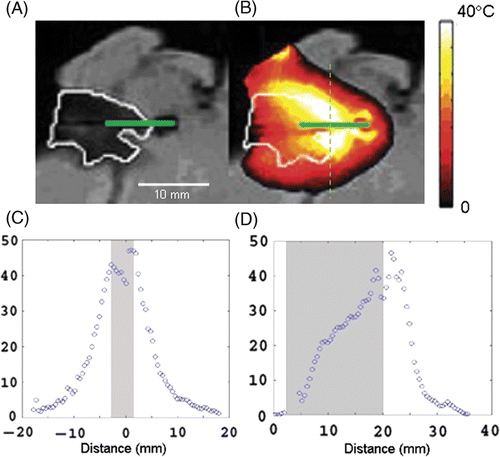Figure 4. Sagittal view of the ex vivo tumour. The dark area outlined in white in (A) is the tumour phantom, the green solid line represents the laser probe. (B) The highest temperature increase was 45°C in this plane above background and is seen at the boundary of tumour and healthy tissue. The end of the laser probe passes through the tumour into the healthy tissue beyond. (C) shows temperature distribution through the dashed line in (B). (D) shows temperature distribution along the laser fibre.