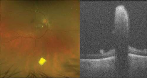 Figure 1. Candida endophthalmitis. Ultra-widefield pseudocolor shows vitritis and a white infiltrate on the surface of the retina, invading the vitreous chamber. The optical coherence tomography of infiltrate confirms its proximity to the retina.