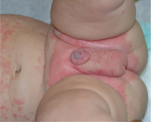 Figure 3 Psoriasis in infants often localizes to the diaper area.