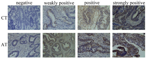Figure 1 Immunohistochemical was used to detect of SOCS3 expression in cancer tissues and adjacent tissues of CRC patients.
