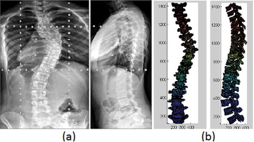 Figure 6. Subject-1 (a) Biplanar x-rays (b) CSCPG model.