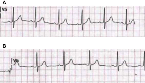 Figure 3 Electrocardiograms with the sacral neuromodulation device in both on and off modes. (A) An electrocardiogram performed with the sacral neuromodulation implant in “off” mode shows no changes and a sinus rhythm in a patient on antiarrhythmic medication. (B) An electrocardiogram performed with the sacral neuromodulation implant in “on” mode shows no changes and a sinus rhythm in a patient on antiarrhythmic medication.