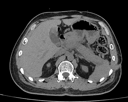 Figure 4 The CT scan shows a significant improvement in peripancreatic effusion, and the area of necrosis in the neck of the pancreas has noticeably decreased compared to before.
