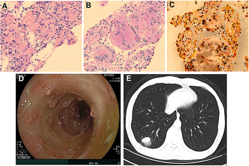 Figure 2 Hematoxylin and eosin stained (A), periodic acid-Schiff stained (B) and hexamine silver stained (C) section of core biopsy of lung lesion (200×). Multiple variable size encapsulated yeast cells are present (arrows). After vedolizumab treatment for 3 times, reexamined colonoscopy showed a slight pseudomembranous colitis in rectum sigmoid colon (D). After 3 months of treatment with voriconazole, the lung lesions were absorbed mostly (E).