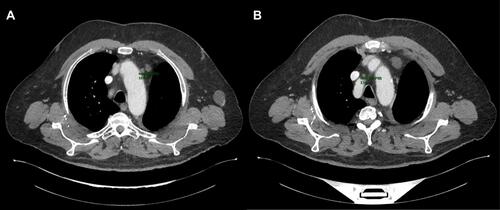 Figure 4 CT scan of June 11, 2020 showing a partial response aspect (RECIST 1.1) of two mediastinal lymph node involvements, the first in front of the aortic arch (A) and a second one of 18 mm in the pretracheal space (B).