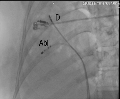 Figure 6 Fluoroscopic image with a modified anteroposterior projection showing an ablation catheter at the region of the slow pathway (Abl) and a quadripolar diagnostic catheter on the His bundle position (D).