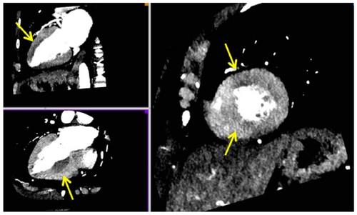 Figure 7 An example of perfusion defects (yellow arrows) seen in the anterior wall and inferoseptum using CCT in the long axis (left) and short axis (right).