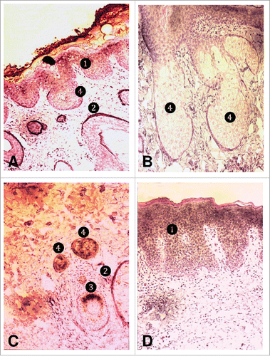 Figure 3. Detection of cellular compartmentation of RIS-1/psoriasin mRNA expression by in situ hybridization. A) Normal skin (40x), B) normal sebaceous glands (100x), C) acne skin (100x), d) psoriatic skin (40x). (1) Stratum granulosum; (2), follicular outer root sheath; (3) follicular inner root sheath; (4) sebaceous gland.