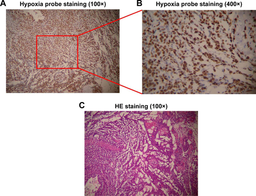 Figure S3 (A and B) Hypoxic areas exist in OSCC tumor tissues and hypoxia probe staining of tongue squamous cell carcinoma tissues. Cells stained in brown color are exposed to hypoxic field and fields stained in blue represent normal atmosphere. (C) HE staining of the PDX tumor specimen.Abbreviations: OSCC, oral squamous cell carcinoma; PDX, patient-derived tongue tumor xenograft; HE, hematoxylin and eosin.