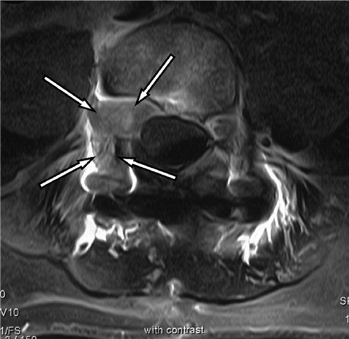 Figure 5. Axial MRI after application of contrast medium showing the second recurrence of the tumor (between arrows).