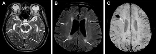 Figure 1 Magnetic resonance imaging of the patient’s brain.
