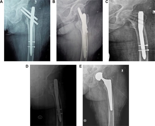 Figure 2 (A–E) Femoral head fracture due to the lateral thigh pain in a patient in whom PFN screws were removed undergoing partial hip arthroplasty.