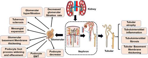 Figure 2 Pathological characteristics of DN. The first clinical manifestation of classical DN is the increase of urinary albumin excretion. The glomerular filtration rate is normal or even increased before urinary albumin excretion, but the glomerular filtration rate decreases after continuous urinary proteinuria, and eventually even developed into ESRD. And with increased urinary albumin excretion and an independent decline in glomerular filtration function, the patient’s risk of cardiovascular disease increases. According to the Tervaert classification of DN, the glomerular lesions of DN can be divided into four grades. I: Irregular thickening of the glomerular basement membrane was observed under an electron microscope. II: Mesangial hyperplasia and mesangial dilatation occur. III: There is at least one recognized tuberous sclerosis. IV: Advanced diabetic glomerulosclerosis of glomeruli.