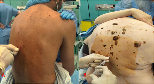 Figure 1 Insertion of the needle at T8–9: (A) paramedian approach. (B) median approach.