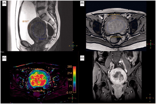 Figure 2. A 38-year-old woman with a 116 ml adenomyosis was treated with magnetic resonance imaging (MRI)-guided high-intensity focussed ultrasound (HIFU) ablation. (A) A sagittal T2-weighted (T2W) MR image of the adenomyosis prior to HIFU treatment. (B) A quantitative perfusion MR image was analyzed by drawing a region of interest (ROI) within the area of the adenomyosis lesion and the myometrium on one of the perfusion MR images. (C) The generated Ktrans map (lower left, left section). (D) A contrast-enhanced T1-weighted (CE-T1W) MR image obtained immediately after MRI-guided HIFU treatment.