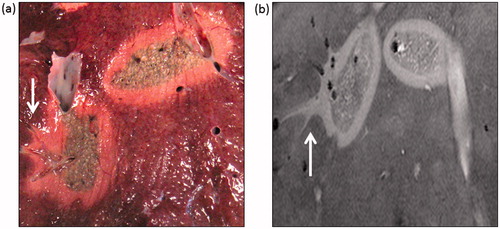 Figure 4. Comparison of Microwave ablation (MWA) zone characteristic with the Magnetic resonance (MR) image appearance. (a) A macroscopic section showing the extension of the ablation zone along a hepatic vein on the leftmost ablation zone (arrow) at an approximately similar plane as the following MR image. Zonal anatomy of the ablation again demonstrated with a central dark (carbonised) zone, inner white zone (coagulated) and outer zone (boundary). (b) Axial 3D Fast low angle shot gradient echo sequence with water selective excitation (3D WATSf) image showing two ablation zones at a similar plane to macroscopic slice. The peripheral, higher signal component of the leftmost ablation zone extends along the adjacent hepatic veins (arrow).