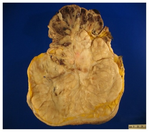 Figure 2 Sectioning revealed a nodular mass having a tan-white fleshy cut surface with both myxoid and fibrous areas, along with scattered areas of necrosis. The area corresponding to the fungating lesion had a necrotic rim with a hemorrhagic cut surface.