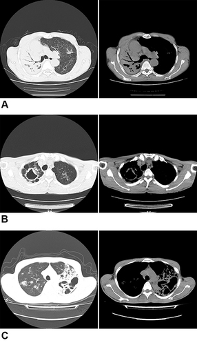 Figure 1 Chest radiograph sign in pulmonary window and mediastinal. (A) Air bronchial sign. (B) Single cavity. (C) Multiple cavities.