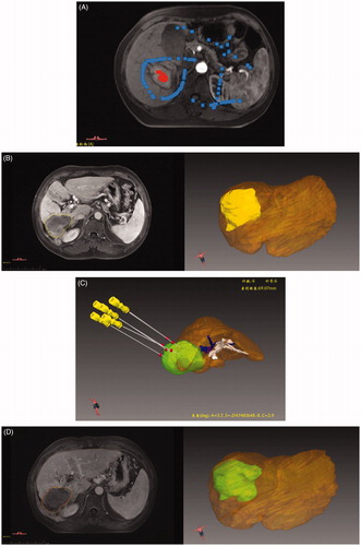 Figure 2. Screenshots show procedure for automatic generation of the 3D volume in the 3D visualization treatment platform and preoperative plan. (A) A HCC tumor was shown in the MRI axial image and we sketched a region of interest (ROI) in the tumor and delete areas around ROI. (B) The tumor was shown in 3D style. (C) Pre-operation 3D visualization treatment platform showed the location of the tumor and the close relationship with the surrounding structures, and six antennas were needed to ablate the tumor completely and safely. (D) The ablative area was shown in 3D style.