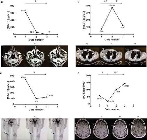 Figure 5. ExoPD-L1 can be used as follow-up markers in melanoma patients. Case study of the correlation between ExoPD-L1 levels in plasma samples from melanoma patients and response to PD-L1-based therapy. Concomitant imaging and ExoPD-L1 sampling in four patients experiencing (a) response as observed in the parotid gland and cervical lymph nodes on CT scan; (b) complete response in the subcutaneous tissue, popliteal and ilioinguinal lymph nodes on PET-CT; (c) disease response in the muscle and infraclavicular lymph nodes on CT scan; (d) initial response (at cure 1) then disease progression as detected in the brain on MRI. R: response, PD: progression of the disease. Tumour metastases in the scans are indicated by an arrow.