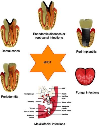 Figure 4 Schematic diagram of the application of aPDT in dentistry. APDT had potential to inhibit many oral infections including caries, endodontic diseases, root canal infections, periodontitis, peri-implantitis, oral fungal infections and maxillofacial infections.Abbreviation: aPDT, antimicrobial photodynamic therapy.