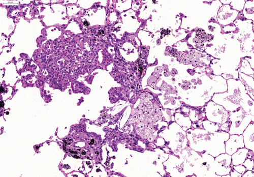 Figure 6.  Slight multifocal accumulation of partly degenerating particle-laden macrophages, slight interstitial fibrosis, inflammatory cell infiltration and bronchiolo-alveolar hyperplasia after repeated intratracheal instillation of ultrafine carbon black (PRINTEX® 90). H&E × 100.