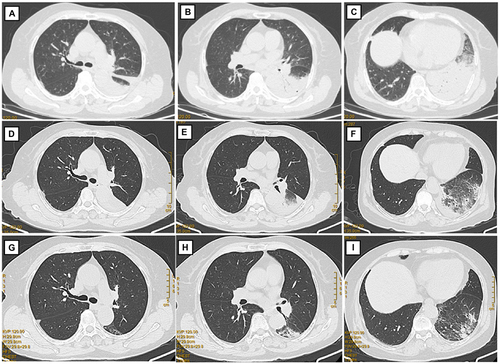 Figure 1 Chest computed tomography. (A–C) Chest computed tomography (CT) on admission showing massive consolidation in the left lower lung field and left-sided pleural effusion. (D–F) Chest CT after 1 week of treatment with moxifloxacin, showing a reduction in the consolidation, lung lesions, and pleural infusion. (G–I) Chest CT after 2 weeks of treatment with moxifloxacin.
