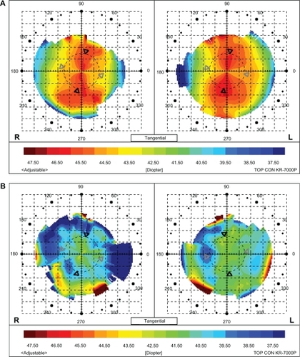 Figure 4 A) Color mapping of a patient before soft toric lens fitting. B) Color mapping of the same patient after soft toric lens fitting.