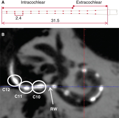Figure 2. Measurement of full insertion depth of the electrode. A standard electrode array with the measures (mm) is shown in (A). On the cone-beam computed tomography (CBCT) image (B), three contacts (C10–C12) were outside the round window (RW) and the intracochlear measures started from the RW.