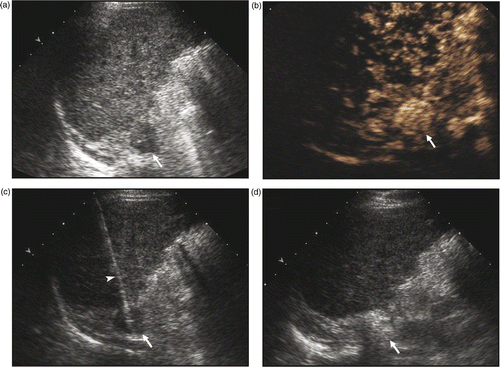 Figure 1. Ultrasound-guided percutaneous MW ablation in a 53-year-old man with right adrenal metastasis (arrow) from hepatocellular carcinoma. (a) Greyscale ultrasound shows a hypoechoic tumour in the right adrenal gland before MW ablation. (b) The tumour (arrow) showed rich enhancement on contrast-enhanced ultrasound. (c) MW antenna (arrowhead) was percutaneously placed into the adrenal tumour (arrow) under real-time ultrasound guidance. (d) The tumour (arrow) became hyperechoic right after MW ablation.