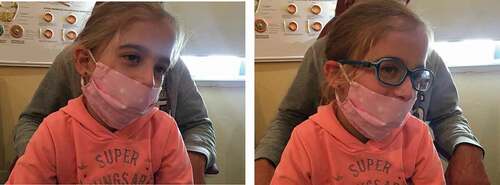 Figure 1. This girl with idiopathic infantile nystagmus (IIN) has a left head turn and slight left head tilt (a). The efficacy of her spectacles is possibly reduced because the visual axis is partially obstructed by the spectacle frame (b)