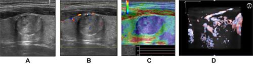 Figure 5 Intermediate risk case (A) with increased stiffness (C) was reconsidered as high risk, regardless of color Doppler (B) or volumetric aspect (D).