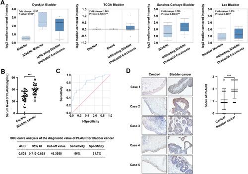 Figure 1 The expression level of PLAUR in bladder cancer. (A) The expression of PLAUR in bladder cancer analyzed with Oncomine database. (B) ELISA assay of serum level of PLAUR in bladder cancer patients and healthy controls. (C) ROC curve analysis of the diagnostic value of PLAUR for bladder cancer. (D) Immunohistochemical staining of PLAUR in tissues from patients with bladder cancer and adjacent normal bladder tissues. The statistical analysis was shown. ***P<0.001.