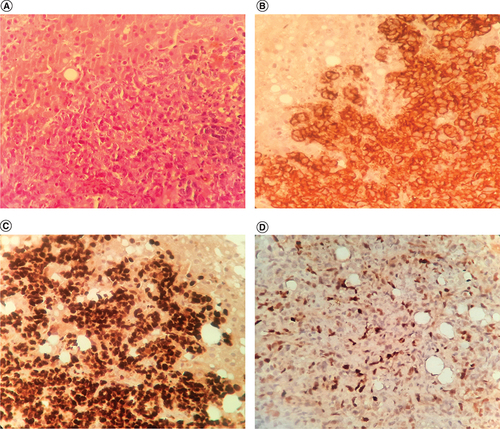 Figure 3. Histopathological and immunohistochemical features at liver biopsy.(A) Histopathological examination of liver biopsy with hematoxylin and eosin (H&E x 200) showing a small to medium lymphoid cell proliferation. (B) Lymphoid cells with diffuse membranous staining with CD20 (IHC x 200). (C) Extensive nuclear staining with Ki-67 reflecting a high proliferation rate (100%). (IHC x 200). (D) Negative staining for C-myc in the lymphoid population (only 10–20% of tumor cells).