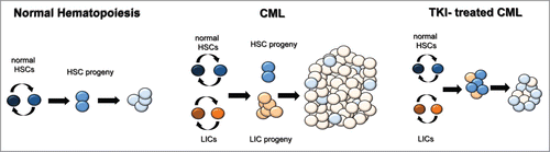 Figure 2. Schematic of stem and progenitor ratios in normal hematopoiesis and hematopoiesis of chronic myelogenous leukemia (CML) cells in the presence or absence of tyrosine kinase inhibitors (TKIs). Cells with all shades of blue are normal; the lighter the shade, the more differentiated the cell. Burgundy (leukemia initiating cells [LICs]), orange (progenitors, e.g., common myeloid progenitora [CMPs], granulocyte monocyte progenitors [GMPs]), and beige cells (differentiated cells, e.g., neutrophils and monocytes) carry the BCR/ABL oncogene.