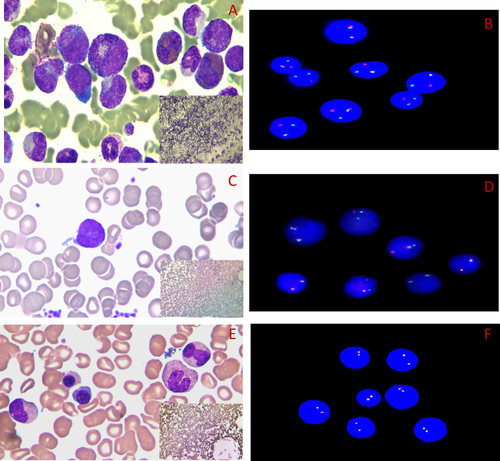 Figure 1 (A and B) Bone marrow at first diagnosis; (C and D) bone marrow during lymph-node invasion of lymphoblastic T cells; (E and F) bone marrow at complete response. (A, C and E) Wright’s stain (100×, 10×). (B, D and F) Interphase FISH results: red (CSF1R), green (PDGFRB), 2 yellow (PDGFRB no breaking), 1 red, 1 green, 1 yellow (PDGFRB breaking detected).