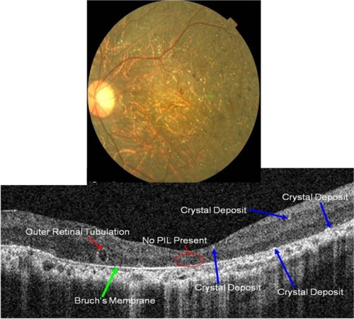Figure 18 Fundus photograph (top) showing BCD triad, glistening crystal deposits, tapetoretinal degeneration and choroidal sclerosis, in the left eye of a patient with BCD; the B-scan line on the fundus photograph has the same width as the B-scan SD-OCT image (bottom) demonstrating the appearance of crystalline deposits and the absence of PIL and RPE layers.