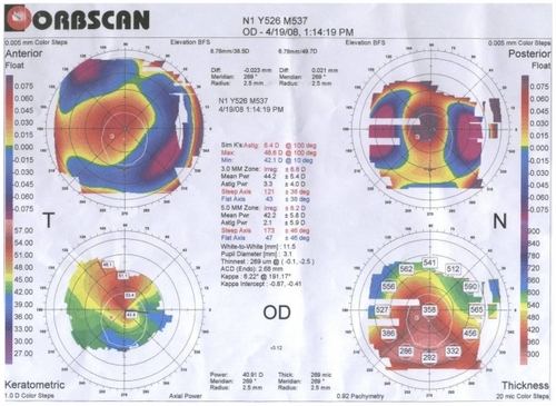 Figure 1 Patient’s preoperative Orbscan II® corneal topography imaging information.