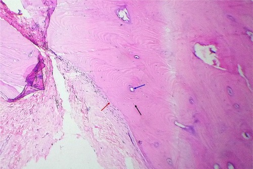 Figure 2 The pathologic section of the mass – well-defined nodule of the bone tissue with Haversian canals and surrounding lamellae (blue arrow) and osteocytes (black arrow). The junction between the conjunctiva and bone tissue is shown by a red arrow.