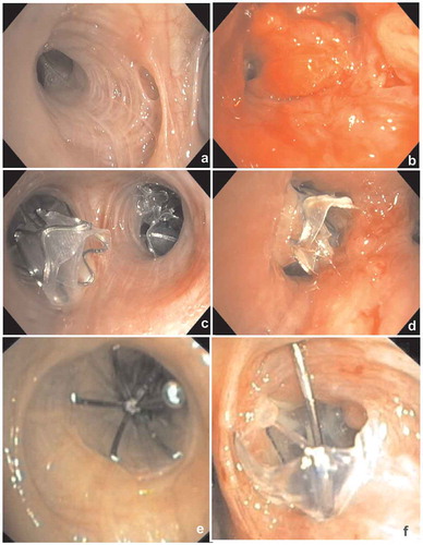 Figure 7. Endoscopic images showing granulation tissue in the segmental airways. (a): RB3 (anterior segment of the right upper lobe) before treatment. B: Same segment (RB3), after removal of the valve, which shows an extensive granulation reaction behind the valve. (c): RB3 and RB2 (posterior segment of the right upper lobe) directly after placement of EBVs. (d): Same position as in C with granulation tissue. E: Endobronchial view of an SVS directly after placement. (f): Endobronchial view of the SVS being displaced with granulation tissue formation
