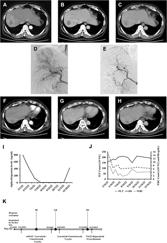 Figure 2 Changes in case 2 in imaging and laboratory tests during clinical treatment. Enhanced CT images before introducing mHAIC. A 6×5 cm mass is shown in the right liver in the arterial phase (A), portal phase (B) and delayed phase (C). (D) Hepatic angiography showing the thread and streaks sign, which implies a vascularized tumour thrombus. (E) After 4 cycles of mHAIC, DSA clipping of the hepatic arteries showed no tumour staining. Enhanced CT images after introducing mHAIC. A 2.0×1.5 cm mass is shown in the right liver in the arterial phase (F), portal phase (G) and delayed phase (H). (I) AFP level changes during postoperative mHAIC. (J) Changes in WBC, PLT and HGB of patients during treatment. (K) Timeline of the treatment process.