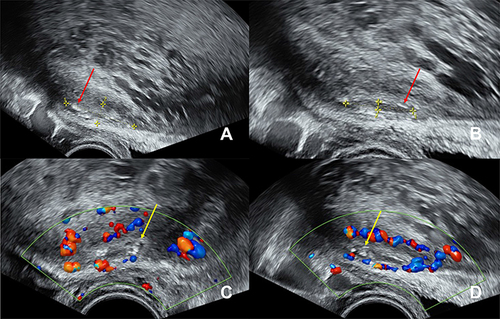 Figure 3 Transvaginal ultrasound in January 2023 during the second trimester of pregnancy, depicting the area of the anterior uterine wall to the left. In (A) and (B) the cystic adenomyoma is marked by the yellow measurement lines. It is practically only discernible by the marginally located hyperechoic spots (red arrows). The ground-glass content has dissolved. (C) and (D) show the peripheral blood vessels surrounding the cystic adenomyoma by color Doppler imaging. The hyperechoic spots indicate the former inner cyst wall (yellow arrows).