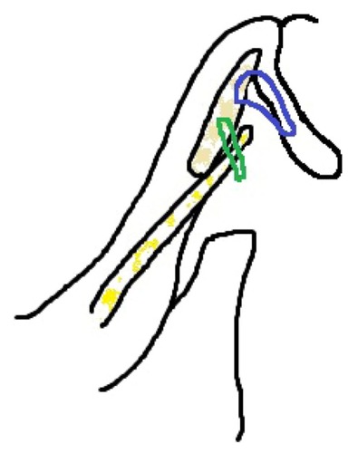 Figure 2 A simple diagram of the lower eyelid and our combination procedure.